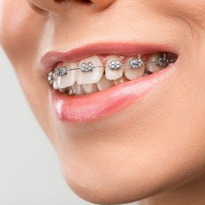 Ortodonti (İnvisalign Tedavisi)